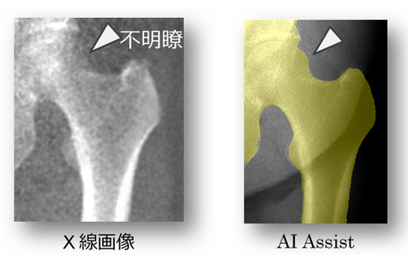 骨密度測定が簡便にできるAI アシスト機能