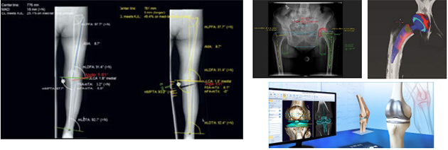 整形外科デジタルプランニングツール「mediCAD」イメージ