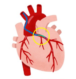 図2　ガイディングカテーテル + ガイドエクステンションカテーテル より遠位部までカテーテルを送達することができる