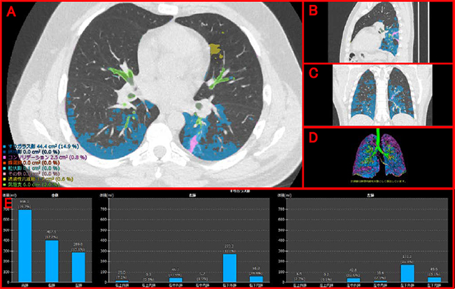 （開発中）新型コロナウイルス肺炎の患者のCT画像および解析結果 A：CT画像のアキシャル像（体を横に切った像），B：サジタル像（体を縦に切った像）， C：コロナル像（体を前後に切った像），D：3D画像それぞれに，病変の識別結果を表示。 E：指定した病変がどの領域にどの程度発生しているかをグラフで表示。