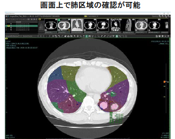 画面上で肺区域の確認が可能