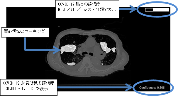 AI医療技術「COVID-19肺炎画像解析プログラム Ali-M3」