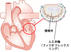 エドワーズ，心臓弁膜症治療用に開発された人工弁輪「フィジオフレックスリング」を新発売