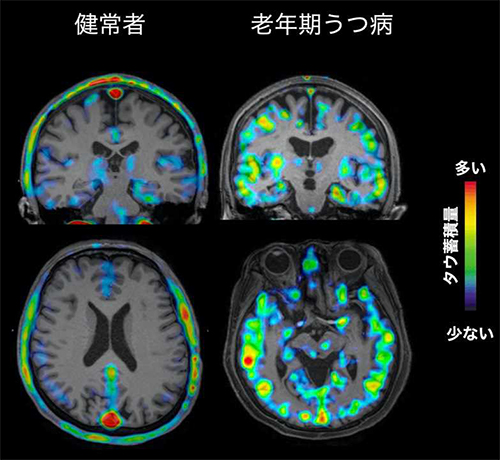 図1 代表的な老年期うつ病におけるタウ蓄積 代表的な老年期うつ病の11C-PBB3 PET 画像。一部の老年期うつ病患者において脳の広範囲にタウが蓄積していた。 色のついているところがタウ蓄積のある部位であり，タウの量は図中のスケールバーの通り少ない（青色）→多い（赤色）で示される。