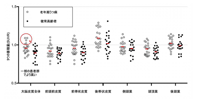 図2 老年期うつ病におけるタウ蓄積 11C-PBB3 PETで調べた結果，一部の老年期うつ病患者においては，健常者と比較して，脳の大脳皮質全体にタウが蓄積していた。また，前帯状皮質にもタウ蓄積が多い傾向が認められた。（小脳の蓄積量との比較。今回の場合，1以上の場合はタウの目立った蓄積があると考えられる）
