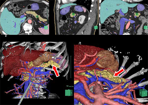 腹腔鏡を用いた手術シミュレーションの際，図中の矢印に示した膵臓と周囲の血管や臓器との位置関係が明瞭に描出されている