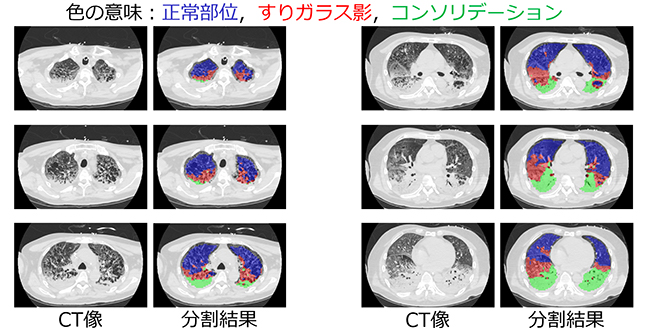 図3 COVID-19肺炎典型度を判定するAIによる部位の分割結果。空気に富む肺胞領域はCTではX線透過率が高いために黒っぽく映る（正常部位）。ここに炎症が起こるとX線透過率が低下してすりガラスのような陰影を呈する（すりガラス影）。さらに細胞浸潤が激しくなると，いっそうX線透過率が低下して白く一様な陰影となる（コンソリデーション）。