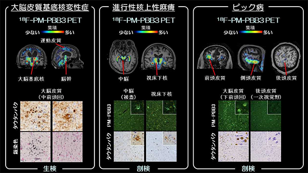 図2　前頭側頭葉変性症患者におけるPET画像，病理所見との関連 大脳皮質基底核変性症，進行性核上性麻痺患者，ピック病患者ともに，18F-PM-PBB3PETで高集積を認めた部位に各疾患に特徴的なタウ病変の蓄積が確認された。