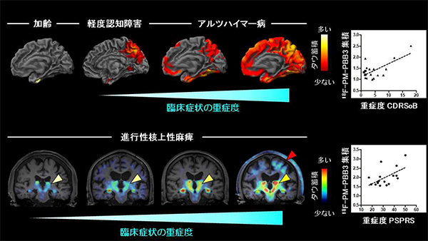 図3　アルツハイマー病・進行性核上性麻痺患者におけるタウの分布と重症度との関連 上図：健常からアルツハイマー病に至るタウの広がりと重症度との関連 下図：進行性核上性麻痺患者におけるタウ蓄積と重症度との関連黄三角は大脳深部のタウ蓄積を，そして赤三角は大脳皮質のタウ蓄積を示唆する18F-PM-PBB3の集積を示す。