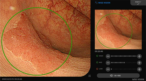 図1「WISE VISION内視鏡画像解析AI」を用いた大腸癌検出の例