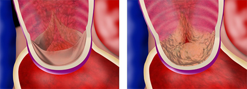 正常な大動脈弁（左）と，狭窄した大動脈弁（右）
