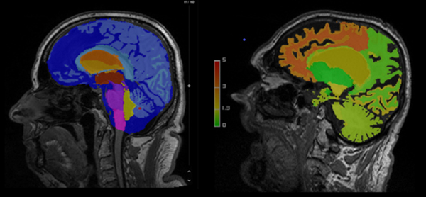 AI-Rad Companion Brain MRの臨床画像