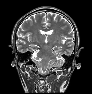 AIR™ Recon DLによる画像再構成