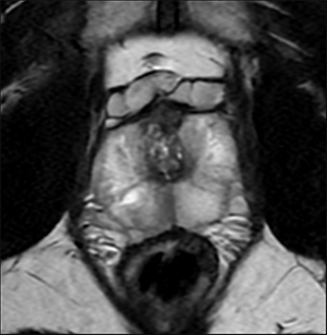 AIR™ Recon DLによる画像再構成（撮像時間:1分47秒）