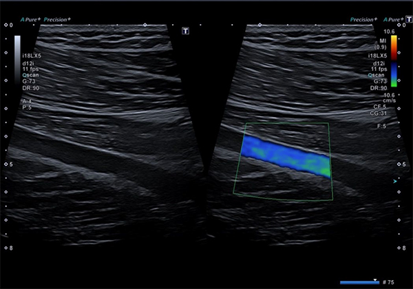 フルフォーカスによる大腿静脈の画像