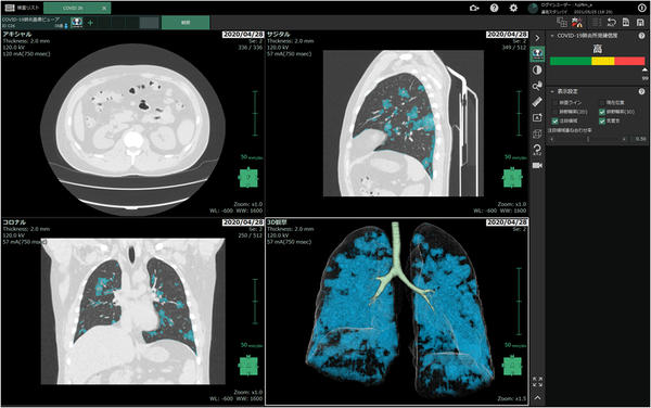 「COVID-19肺炎画像解析プログラム」画面イメージ