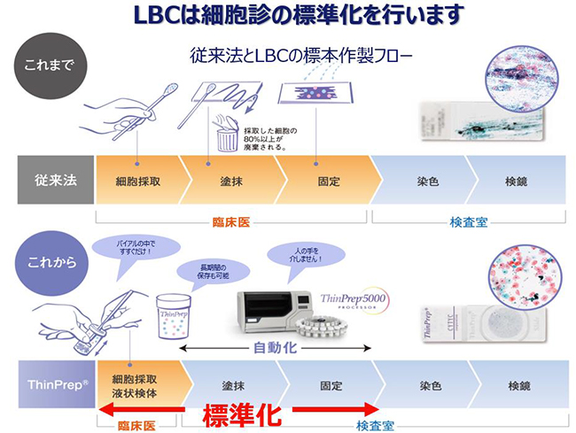 LBC（液状化検体細胞診）とは