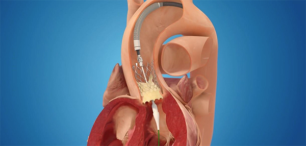 図1 生体弁を大動脈弁の位置に植込む様子