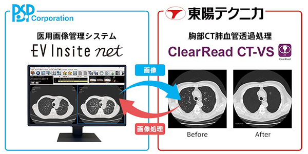東陽テクニカ，胸部読影支援システム「ClearRead CT-VS」がPSP社との医療画像管理システム（PACS）との連携開始