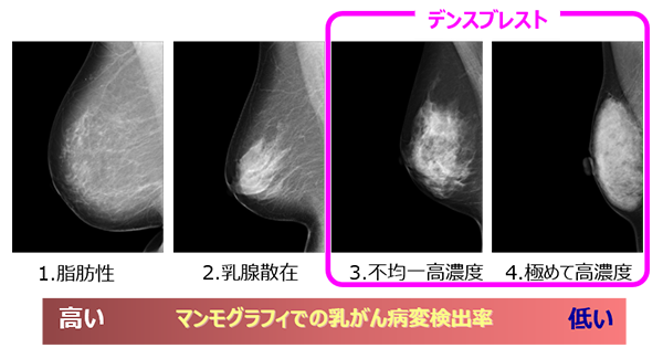 高い画像解析技術により乳房構成判定を支援