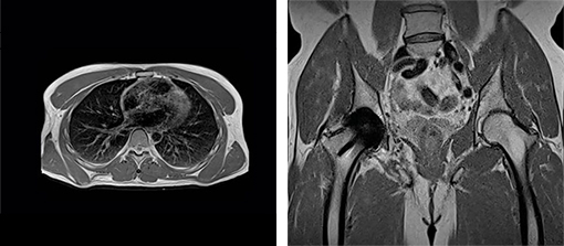 左：0.55テスラによる肺の検査画像 　右：0.55テスラによるインプラントイメージング