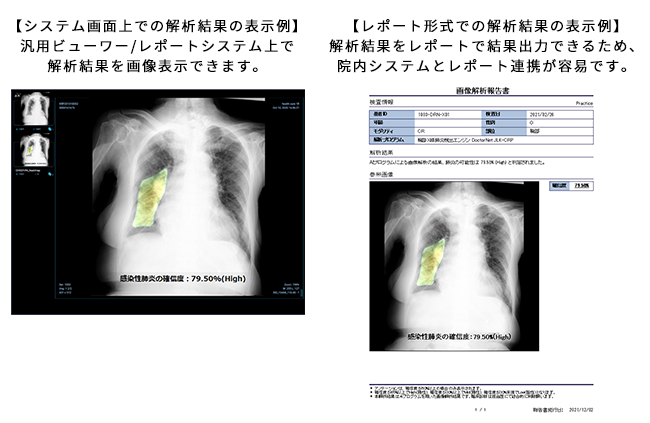 「胸部X線肺炎検出エンジン DoctorNet JLK-CRP」の特長