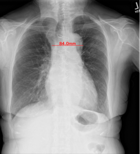 EIRL Chest Screeningによる縦隔幅の計測結果の表示例