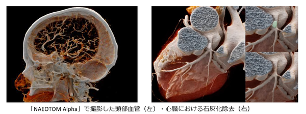 「NAEOTOM Alpha」で撮影した頭部血管（左）・心臓における石灰化除去（右）