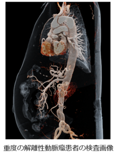 重度の解離性動脈瘤患者の検査画像
