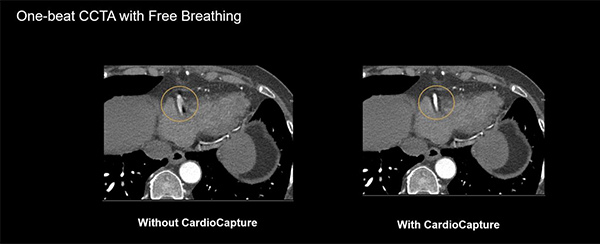 Motion correctionの有無による画像の違い