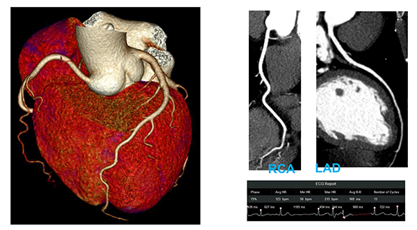 One beat with Free Breathingによる画像（Arrhythmia（50~215 bpm））