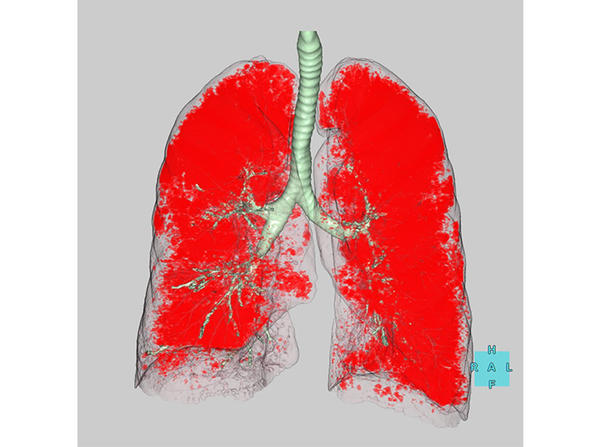 肺解析機能のイメージ
