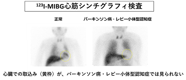 123I-MIBG心筋シンチグラフィ