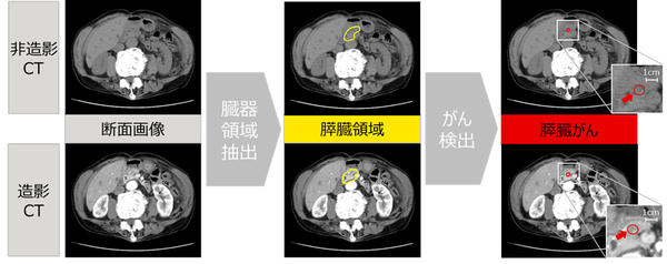 図1：開発する技術による膵臓がんの疑いがある部位の検出イメージ