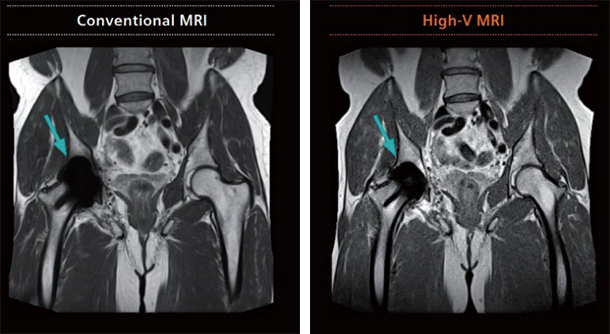 左：従来のMRIによる金属インプラント画像 右：High-V MRIによる金属インプラント画像