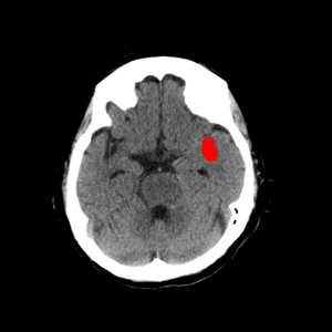 高吸収領域の検出・表示例