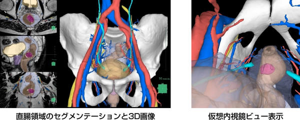 直腸領域のセグメンテーションと3D画像，仮想内視鏡ビュー表示