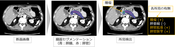 腫瘤（直接所見）および膵管拡張・膵管狭窄（間接所見）を検出した症例（ステージ1）