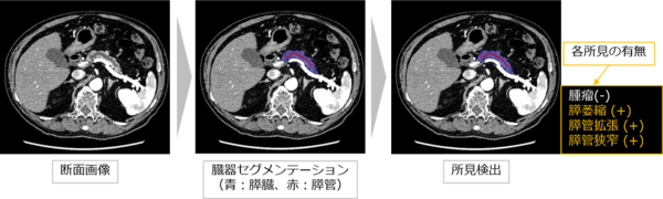 腫瘤（直接所見）が描出されていないが膵萎縮・膵管拡張・膵管狭窄（間接所見）を検出した症例（ステージ0）