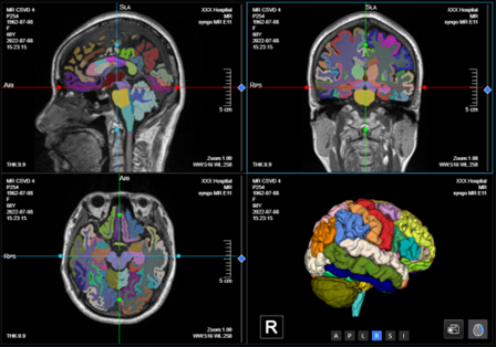 MR AI based Brain segmentation