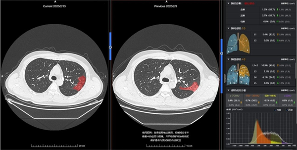 CT Pneumonia analysis