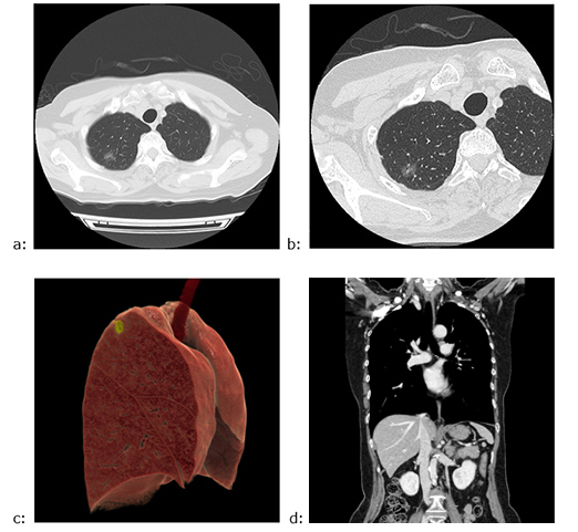 図1　PCCTの肺がん疑い症例 a：胸部CT画像5mm厚，b：Thin slice CT画像， c：全肺野3D画像（黄色部が病変），d：胸部～上腹部造影CT冠状断画像