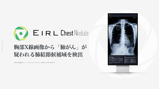 EIRL Chest Nodule