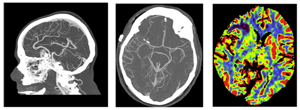 「NAEOTOM Alpha」で撮影した頭部血管の高精細画像（左，中）と脳梗塞を確認するための血流画像（右）　エラスムスメディカルセンター　提供