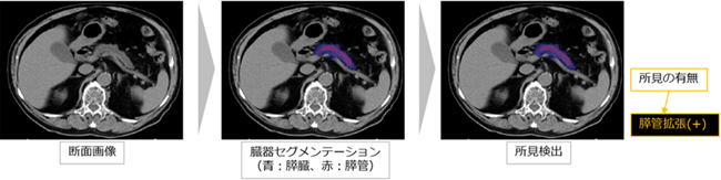 腫瘤（直接所見）が描出されていないが膵管拡張（間接所見）を検出した症例（ステージ0）