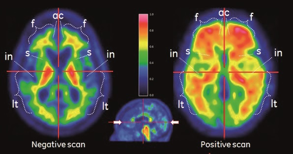 アミロイドβ　陰性画像（negative scan）と陽性画像（positive scan）