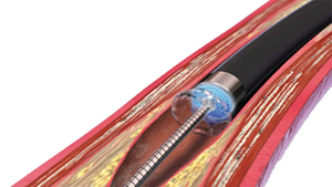 エキシマレーザTurboカテーテル（イメージ）