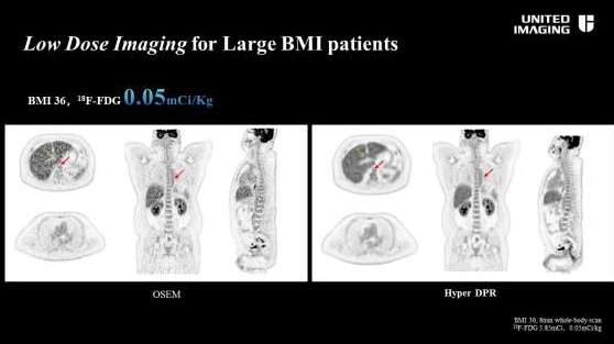 従来のOSEM再構成法とHyper DPRの比較