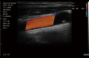 カラードプラ使用イメージ（頸動脈）