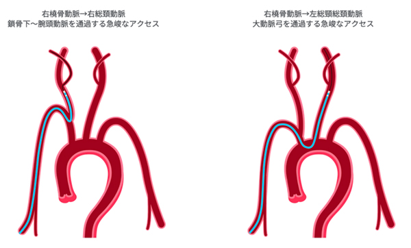 右橈骨動脈→右総頚動脈